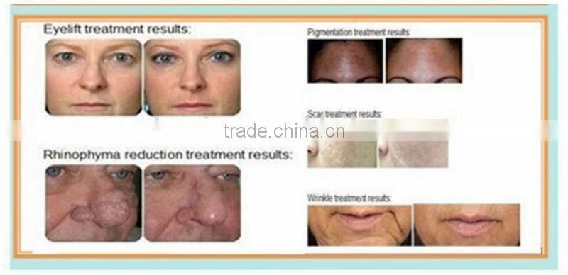 E9S Yag laser tattoo removal + IPL hair removal Machine Profesional Use