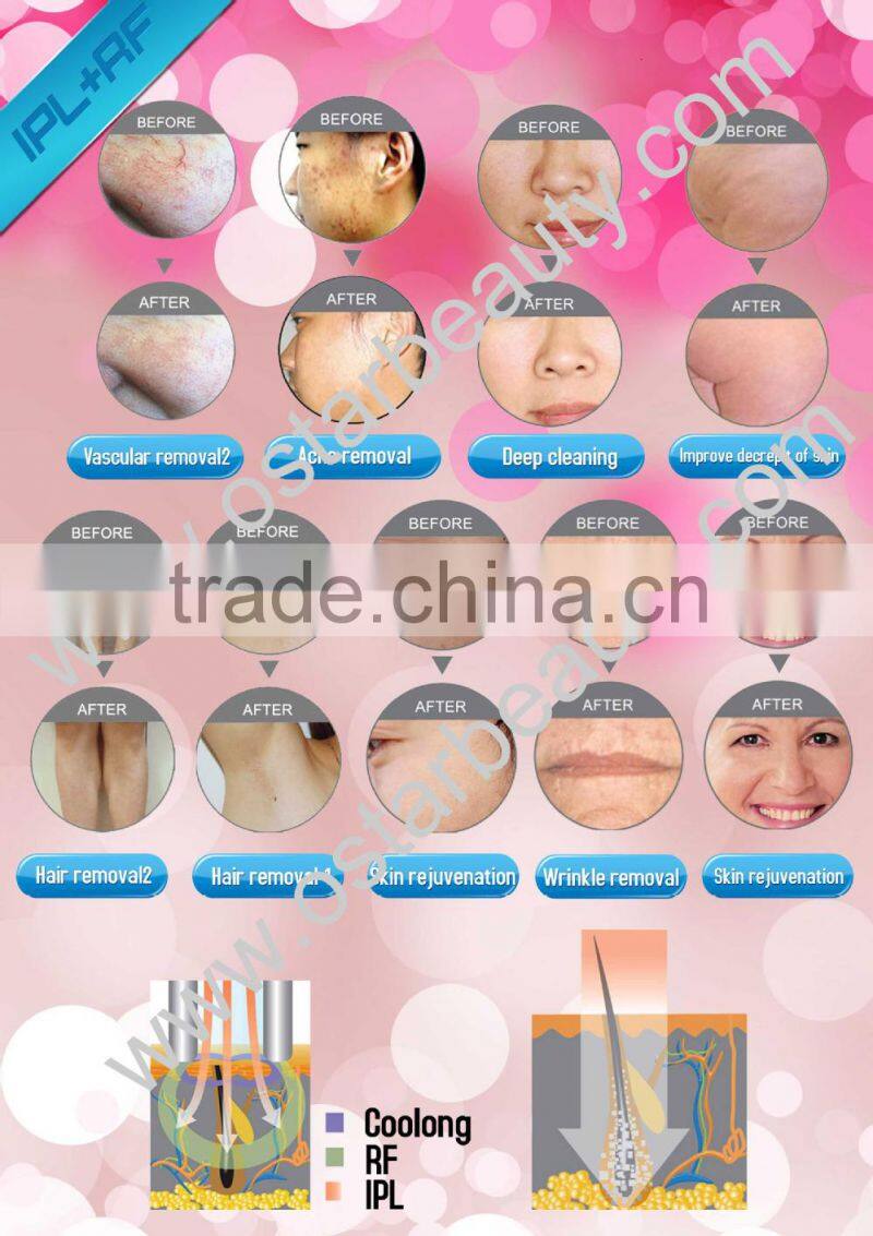 ipl rf wrinkle removal skin rejuvenation e-light machine E 03