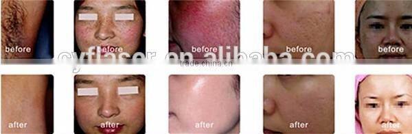 808nm diode laser hair removal machine /808nm permanent hair removal