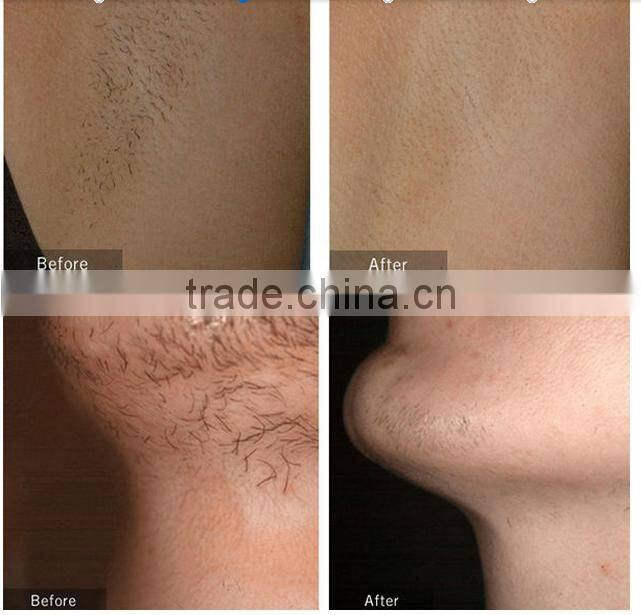 Portable OPT Shr Hair Removal Machine and skin rejuvenation machine