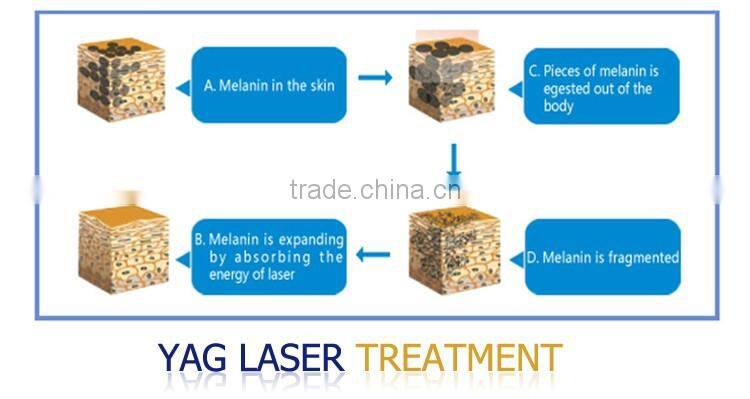 High frequency 10HZ nd yag laser machine to remove freckles OD-LS900