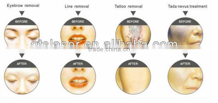 laser ND yag for skin rejuventation,vascular removal ,age spot