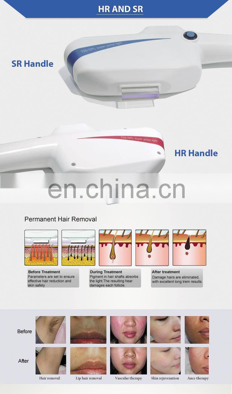 best permenant hair removal machine DPL laser