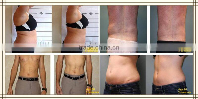 Nubway Lipo Laser Slimming Machine