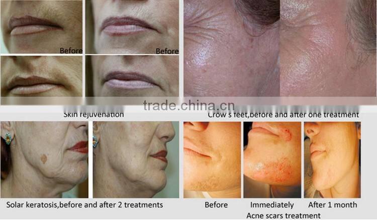 Beauty salon equipment oxygen jet peel spa machine oxygen facial machine