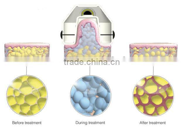 hot sale criolipolise machine