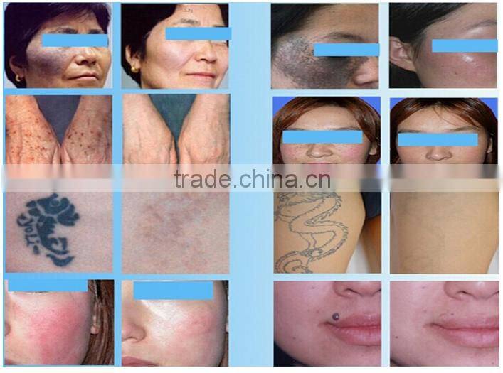 permanent tattoo removal laser machine / Laser nd yag 1064 hair removal
