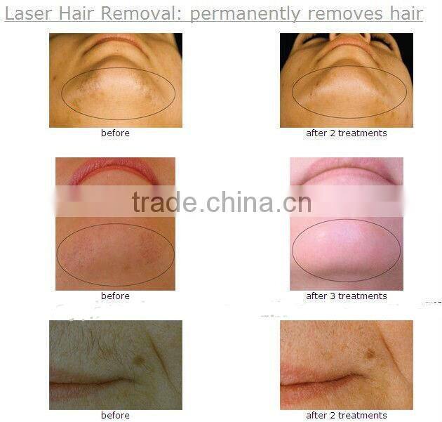 808mm diode laser hair removal /permanent hair removal machine