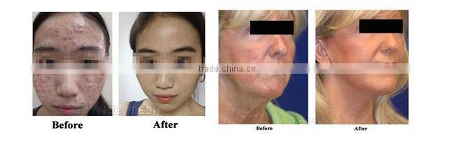 Portable Medical Water Skin Care Oxygen Jet Peel Facial Machine