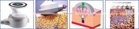 Ultrashape slimming HIFU/Ultrasonix body fat loss/Ultrashape Slimming machine