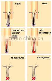 P001 hair laser telangiectasias and varicose veins removal equipment