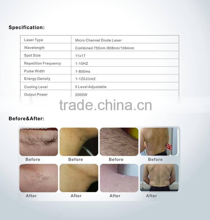 755nm/808nm/1064nm Micro Channel diode laser machine