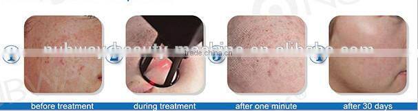 Nubway non-ablative fractional laser