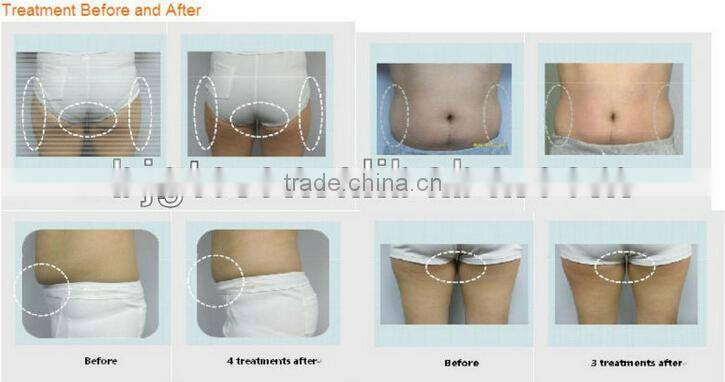 2015 newly-launched portable cavitation+RF slimming machine weight loss machine