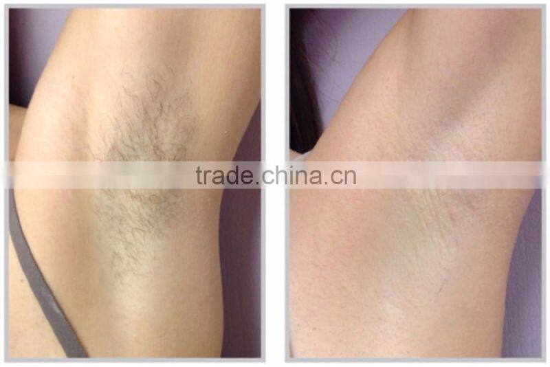 3in1 hair removal, shr laser IPL Nd Yag laser beauty machine