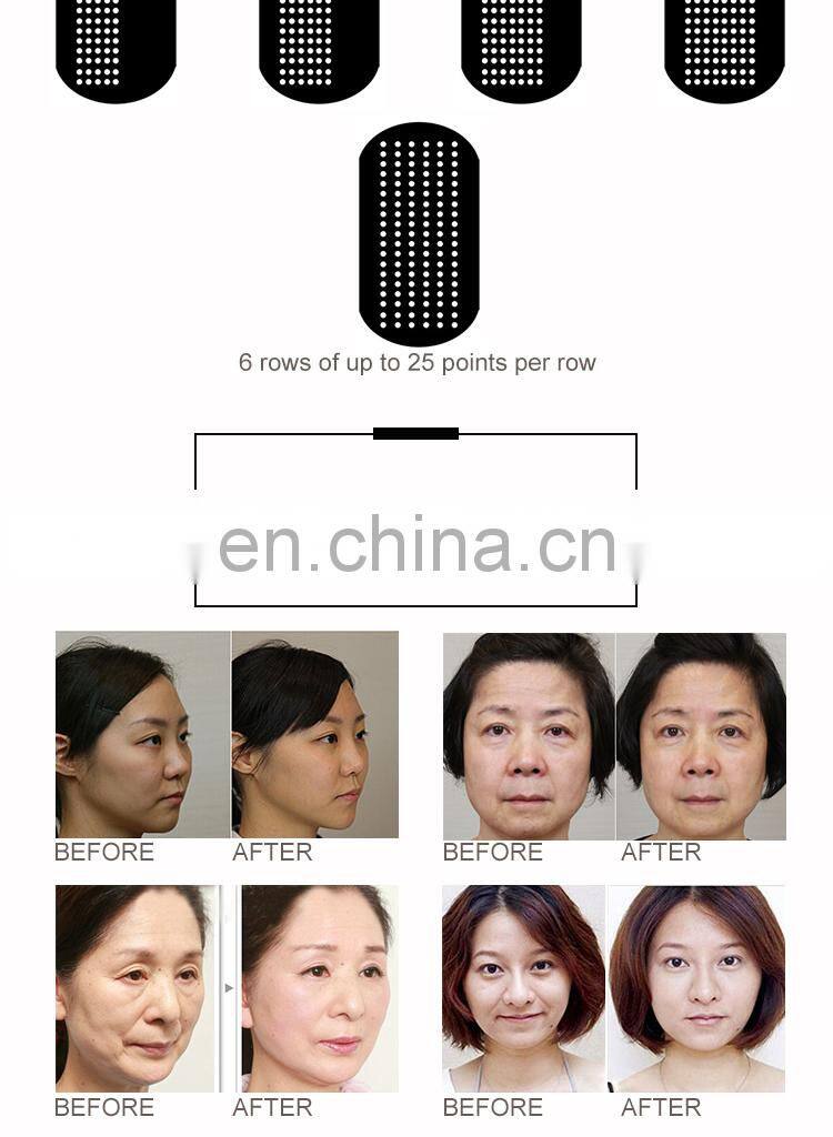 whole sale price hifu beauty machine wrinkle remover for face and facial lifting