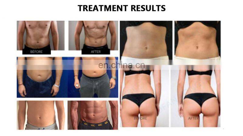 New technology 360 cryo fat freezing electromagnetic abdominal muscle stimulator hip trainer