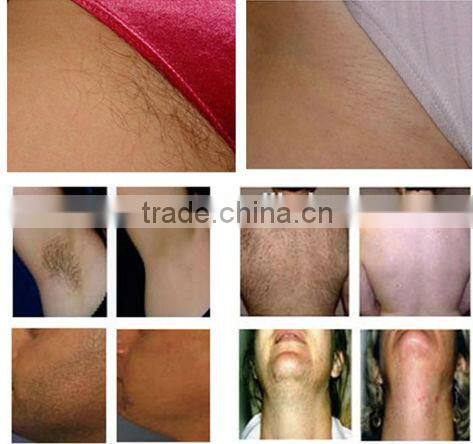 2016 e light hair removal wrinkles removal epilator lady facial device