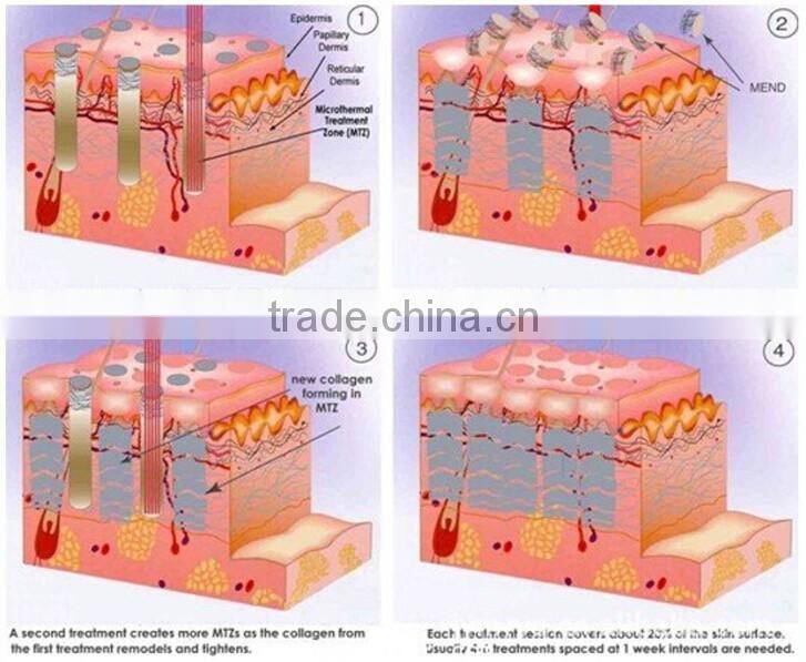 co2 laser treatment, fractional laser skin resurfacing, fractional co2 laser for acne scars