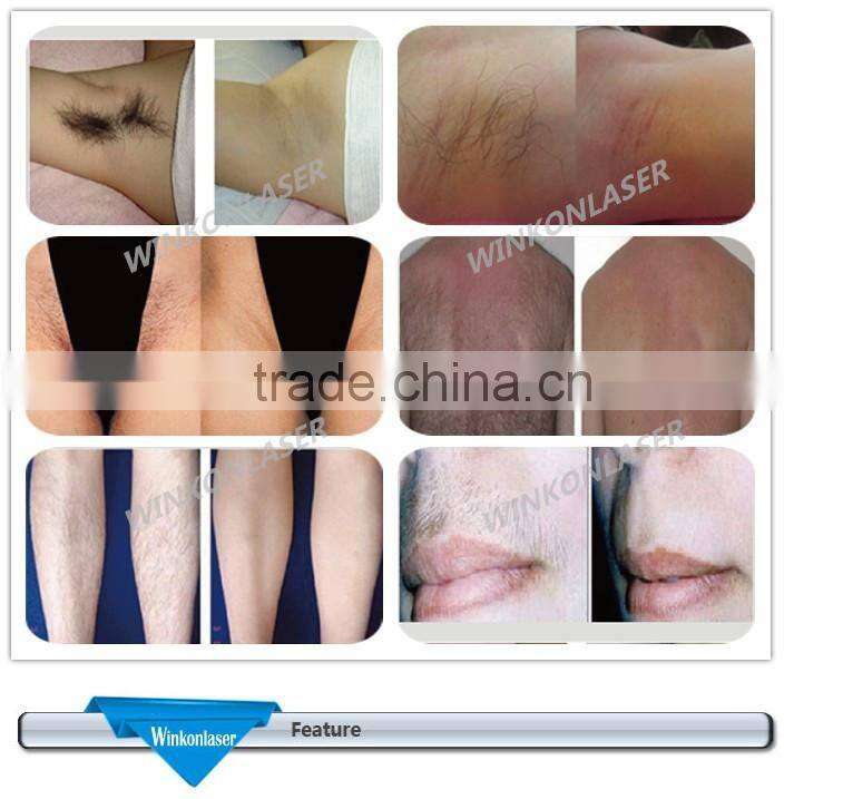 laser hair removal eyebrows / hair laser removal