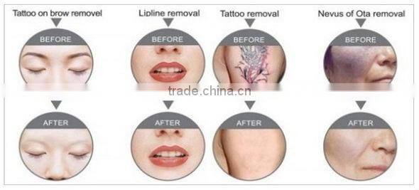 6HZ n d yag laser machines