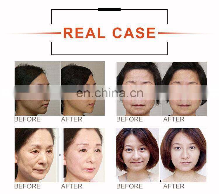 high intensity focused ultrasound hifu face lift beauty machine
