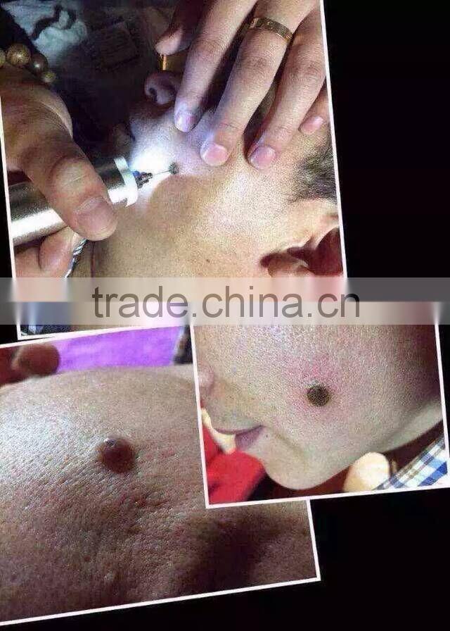 High Frequency Spot Removal Pen speckle removal