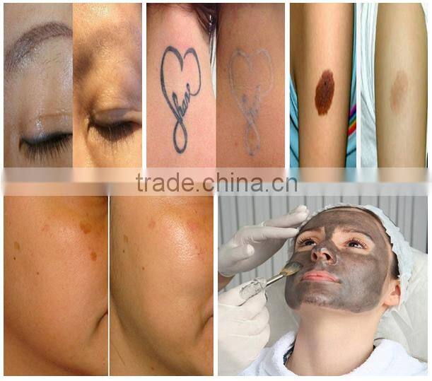 2016 china laser beauty equipment Q-switched nd yag laser tattoo removal 1320nm black doll for salon use