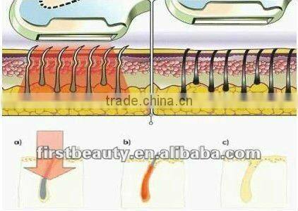 2012professional laser hair tattoo removal machine P003