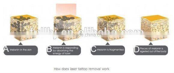 2015 Newest Q Switched Nd Yag Laser Tattoo Remover