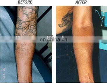 Switch ND YAG Laser price/tatto removal machine/ q swithed laser