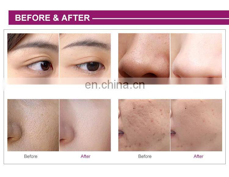 New Original 6 In 1 diamond microdermabrasion high frequency tightening oxygen water jet peel facial machine