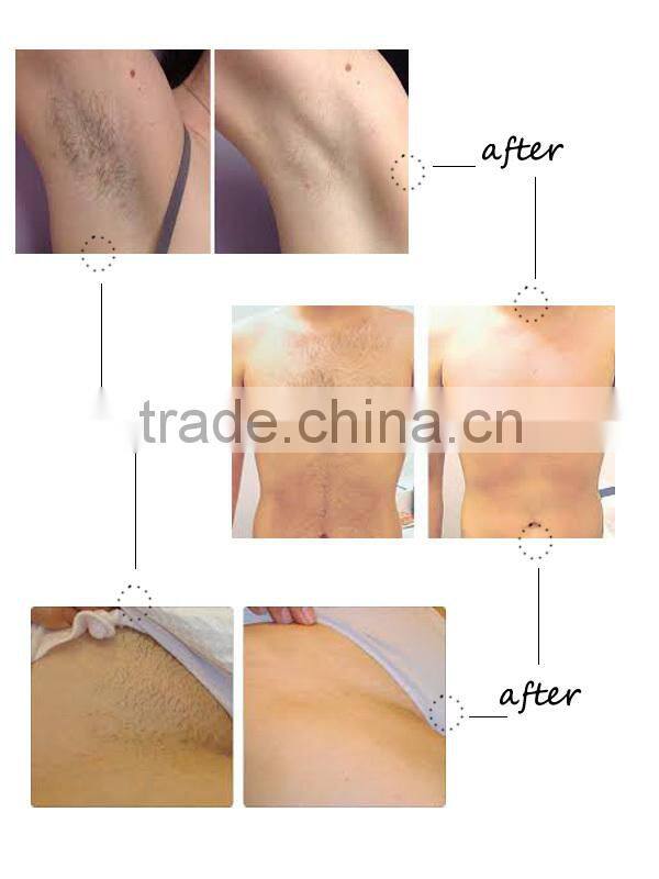 2016 hot sale hair removal machine Permanent hair removel SHR OPT for salon use