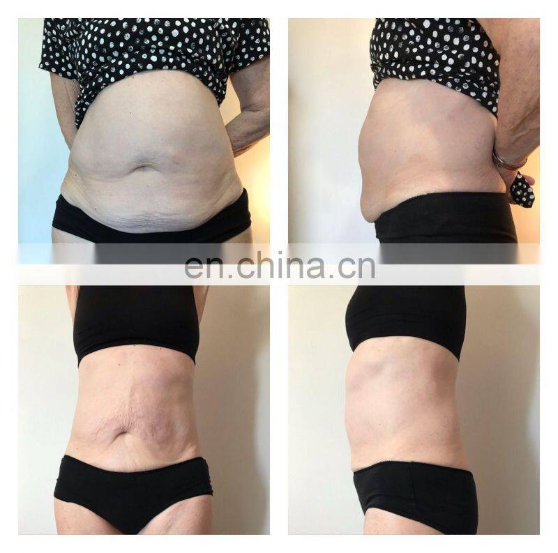 2022 Cryolipolysis Fat Freezing Machine 5 Handles Double Chin Cellulite Remover Cryolipolysis Machine 360