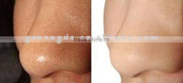 Permanent hair removal machines for skin rejuvenation beauty machine BD-J005