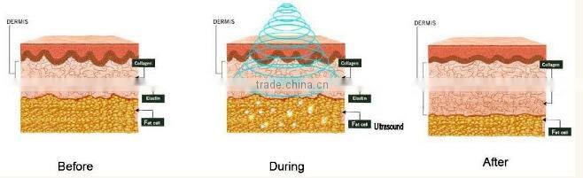 Effective fat reducer!!!! best vacuum rf portable cavitation slimming machine