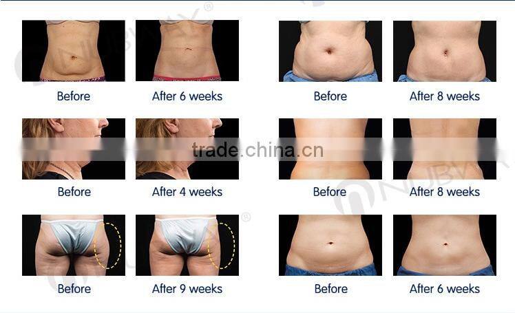 one of the best weight loss method cavitation slimming machine JF-800