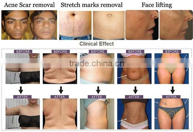 High quality 3 in 1 Multipolar RF+fractional rf+4d Cavitation+skin tighten beauty machine