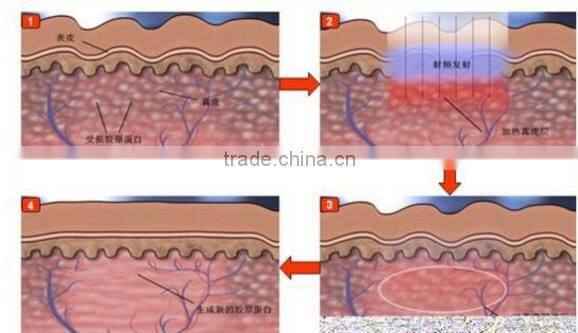 Lipo Freeze Fat equipment For Home/weight Loss Machine/rf DRX-C26