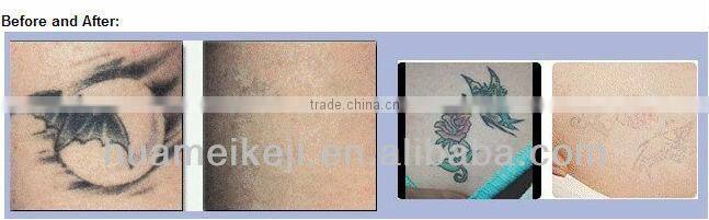 808 Diode Laser Hair Removal Machine with CE,TGA,FDA