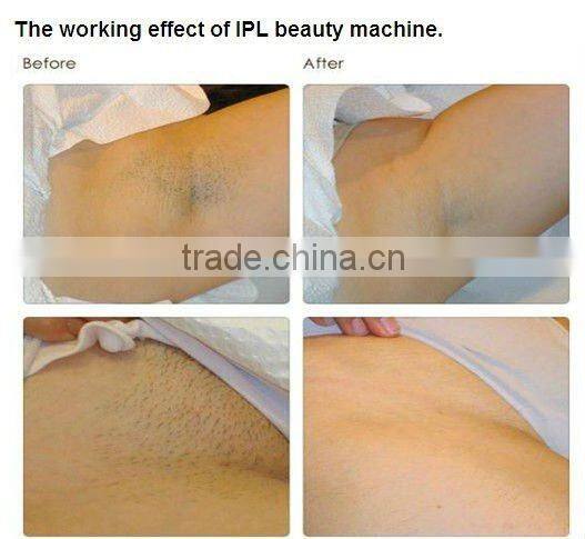 IPL SHR hair removal machine for sale