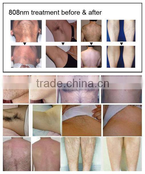 Best laser hair removal equipment for any skin color