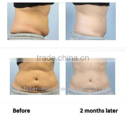 tripolar rf cavitation/cavitation cellulite treatment/ultrasonic liposuction cavitation machine for sale