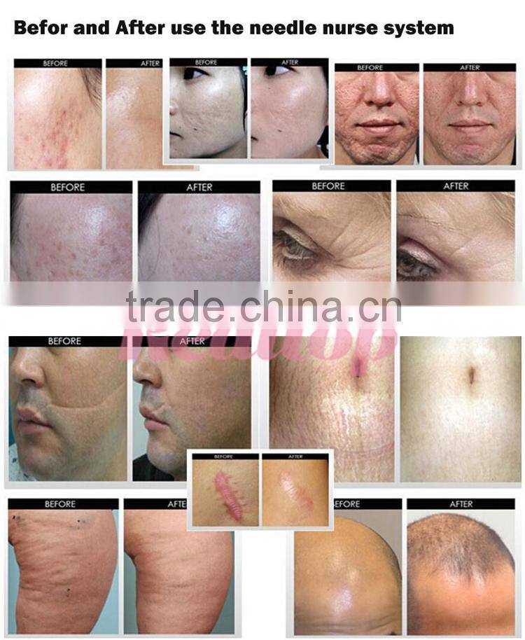 2016 Beauty equipment mezoroller! Dermaroller zgts rollers derma acne removal for skin face massage roller