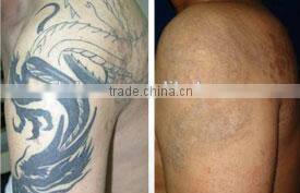 2016 HOT SALSE! new products q switch nd yag laser for tattoo removal system, nd yag laser machine with CE and GOST-P