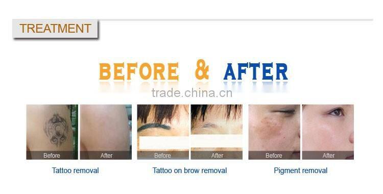 Merry christmas! portable nd yag tattoo removal machine q switch laser for Q1