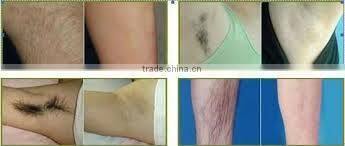 High quality and low price! Professional diode laser/808nm diode laser/laser hair removal for permanent hair removal