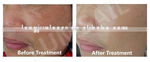 Skin care pdt photon led skin