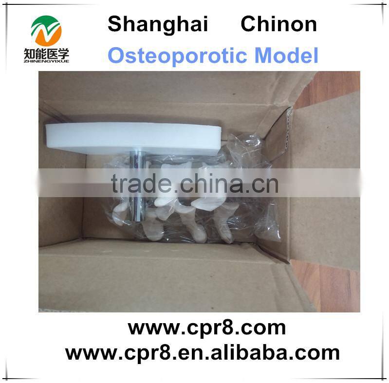 BIX-A1015 Human osteoporosis anatomical Model (3 vertebrae)