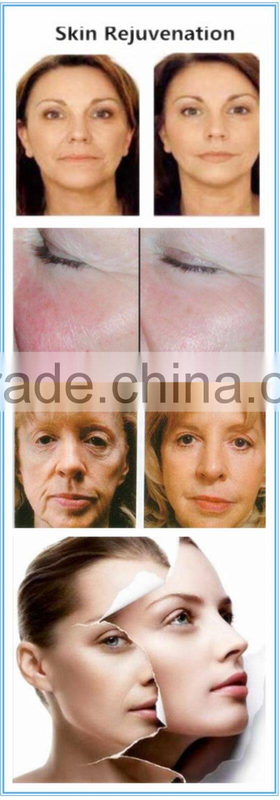 hot selling products hair removal ipl